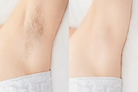 Armhåla före och efter laser hårborttagning